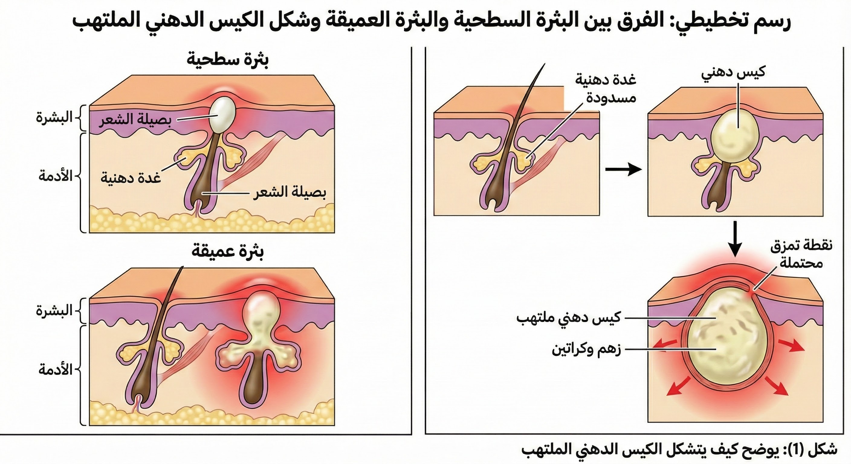 رسم تخطيطي يوضح الفرق بين البثرة السطحية والبثرة العميقة