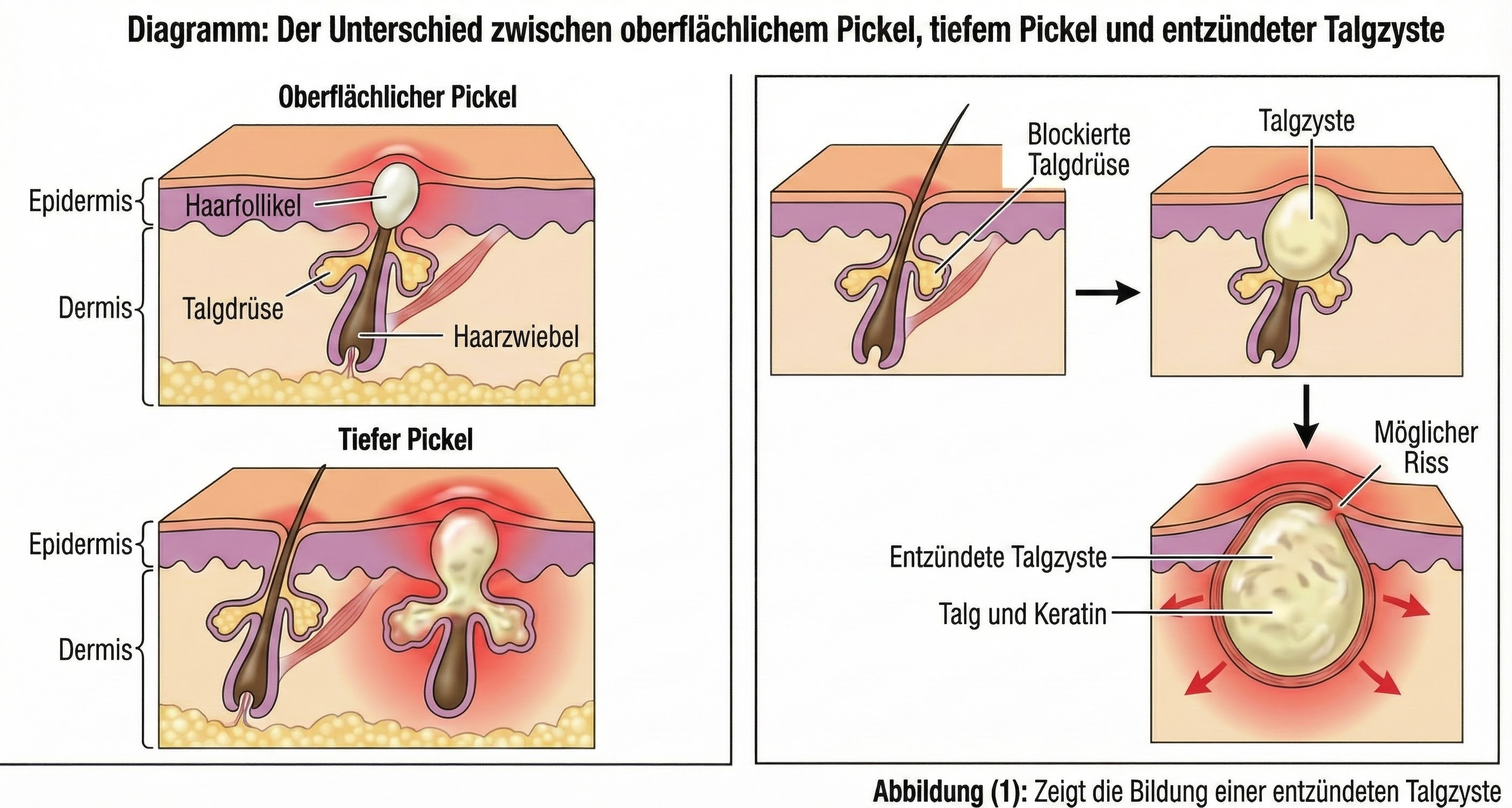 Diagramm, das den Unterschied zwischen Oberflächen- und tiefen Pickeln zeigt