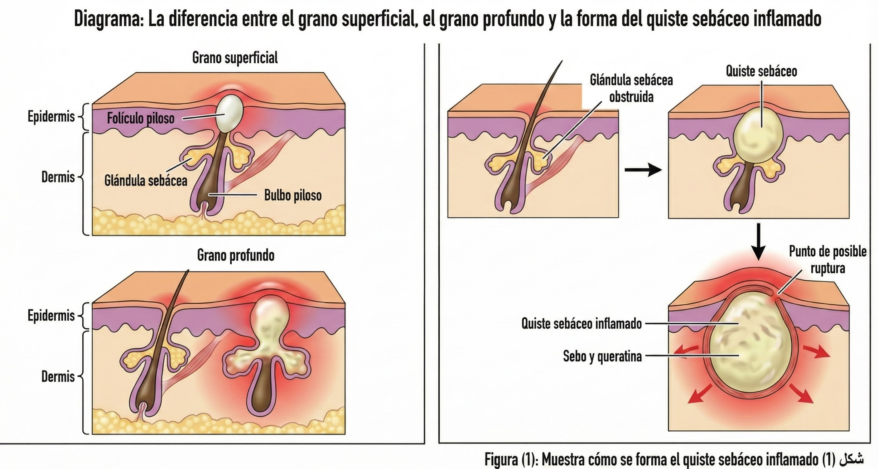 Diagrama que muestra la diferencia entre granos superficiales y profundos