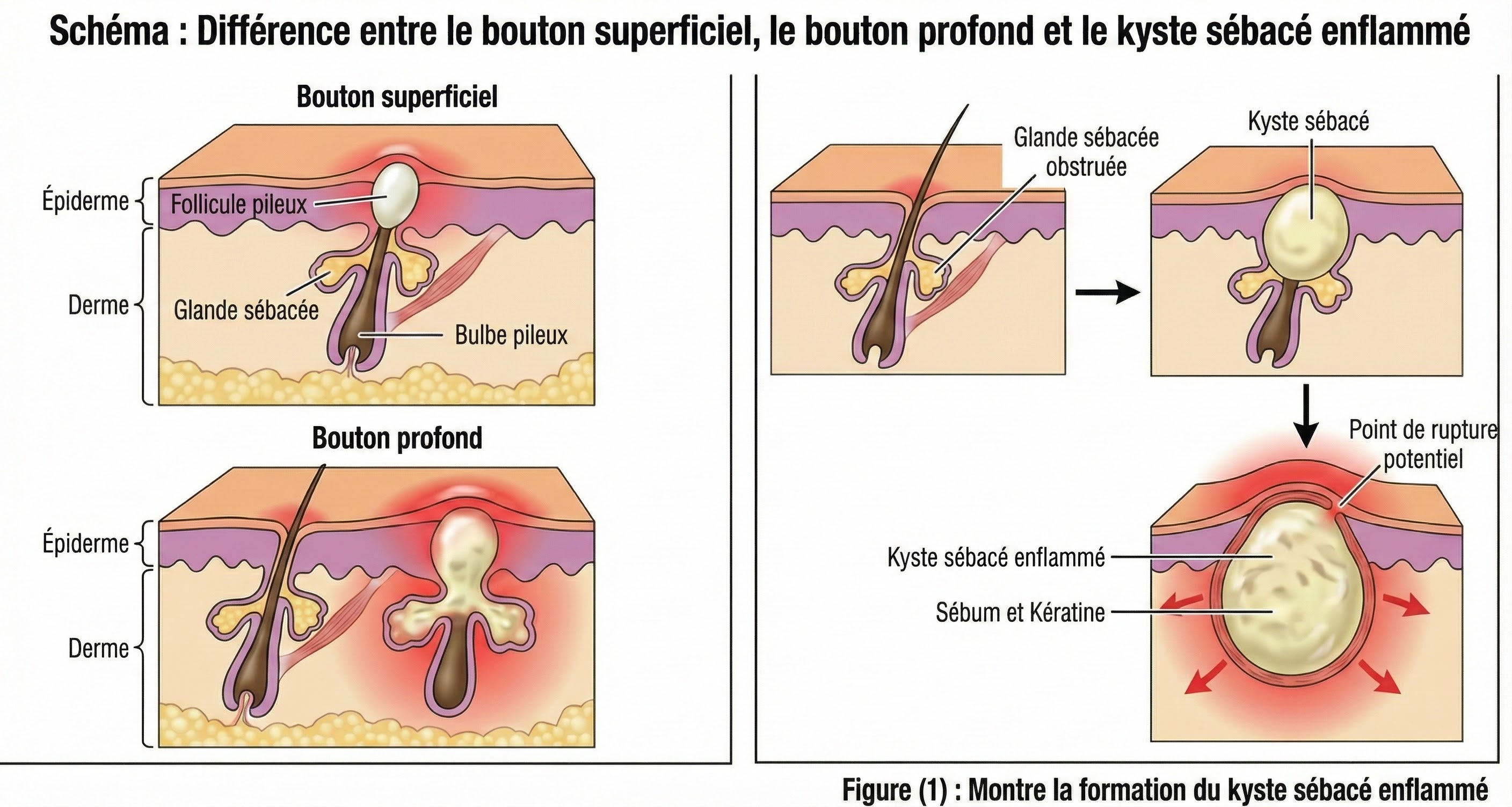 Schéma montrant la différence entre les boutons de surface et les boutons profonds