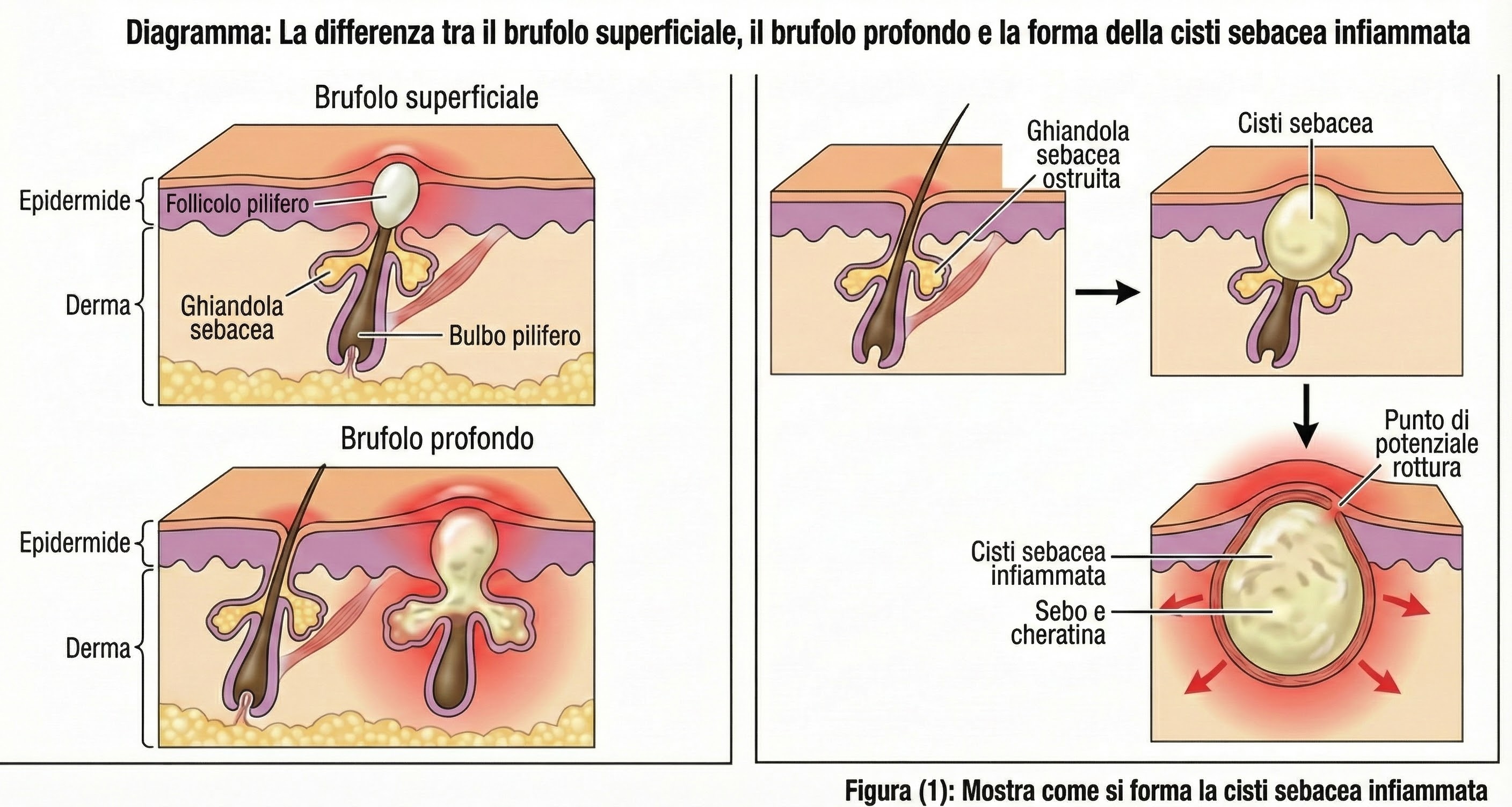 Diagramma che mostra la differenza tra brufoli superficiali e profondi