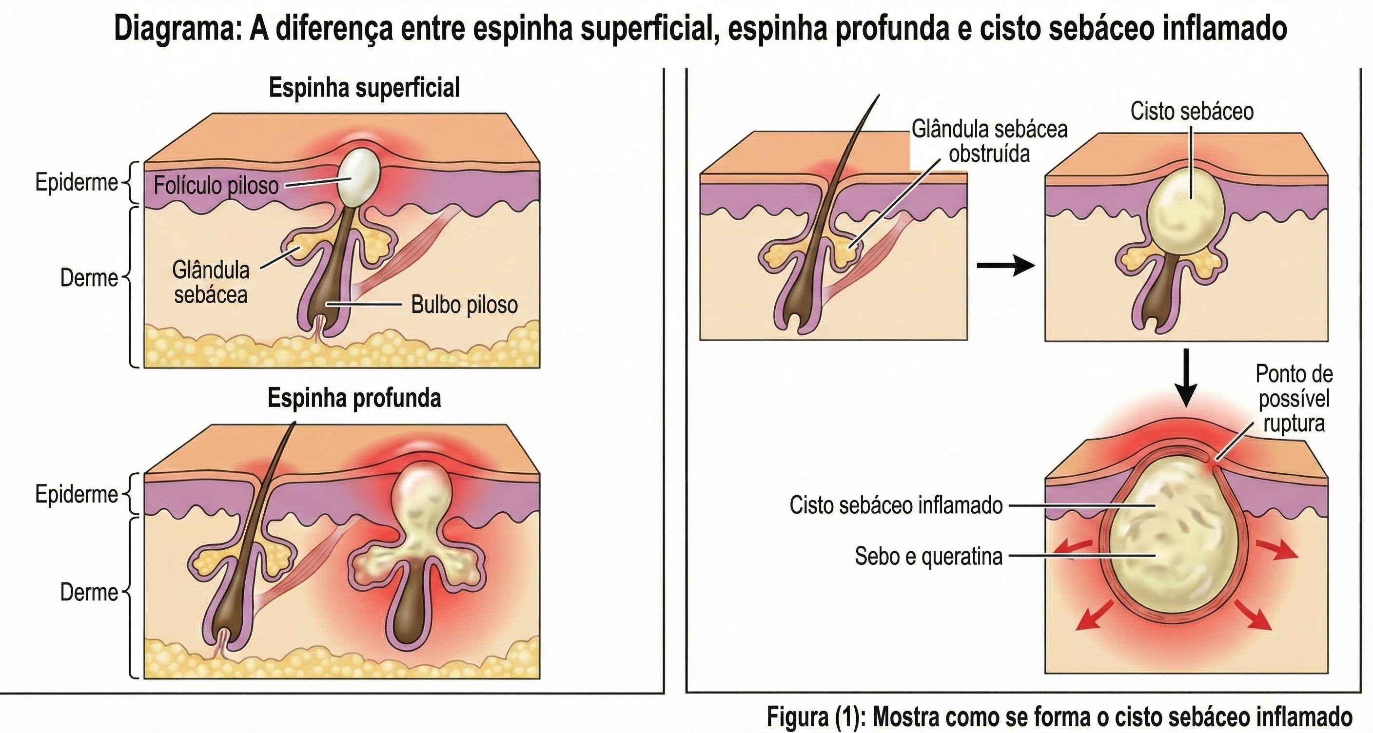 Diagrama mostrando a diferença entre espinhas superficiais e profundas